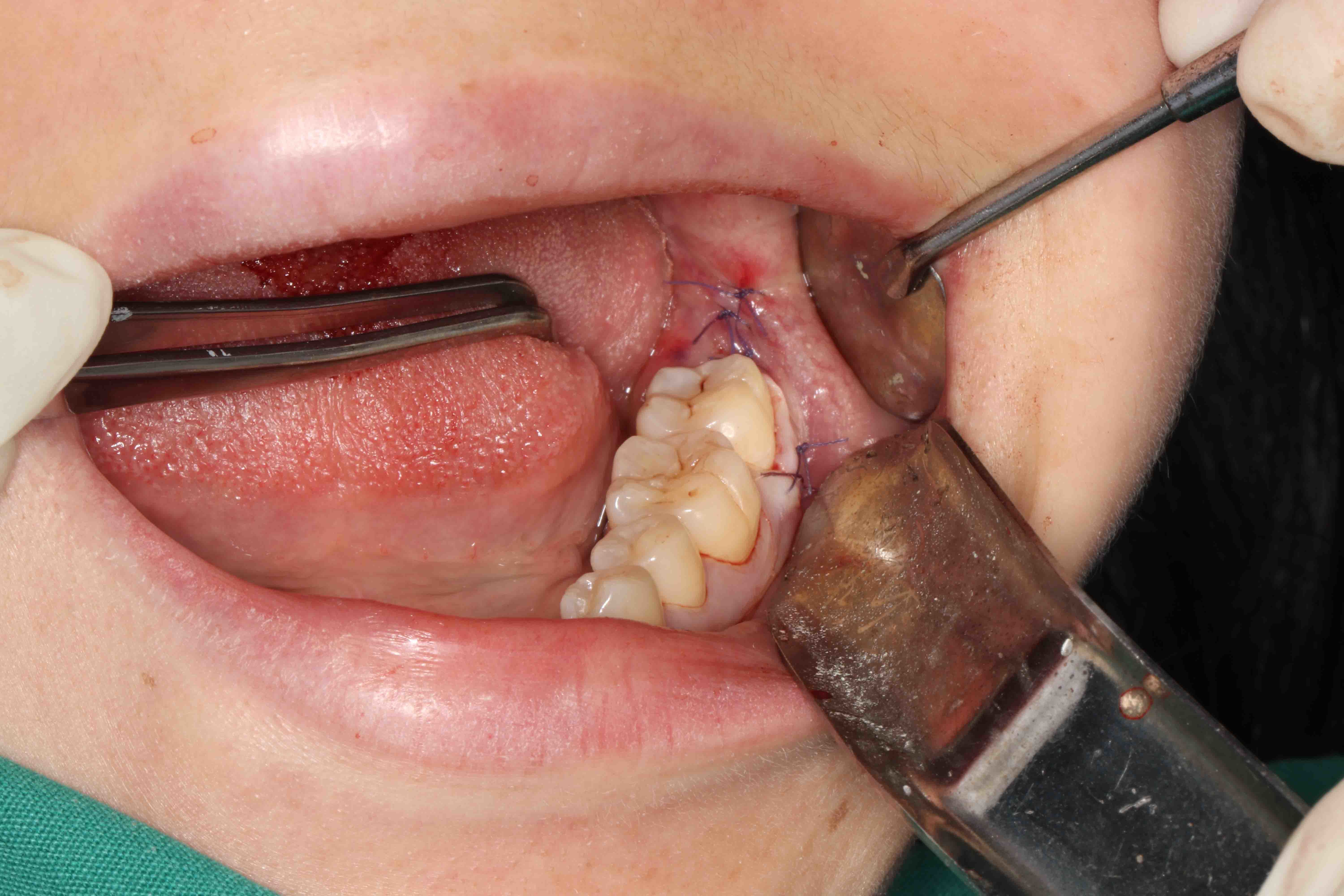 智齿伤口愈合过程图片图片